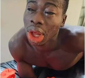 Man Allegedly Blinds Rival With Acid