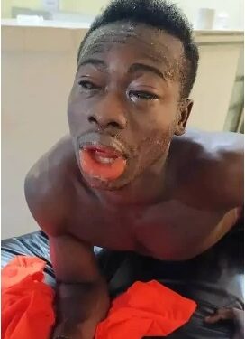 Man Allegedly Blinds Rival With Acid