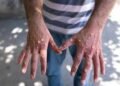 Tonkolili Records 2 Mpox Cases