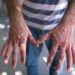 Tonkolili Records 2 Mpox Cases