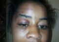 Aminatu Barrie Suffers Horrific Abuse; Police Didn’t Take Case Serious & Her Life Is In Danger