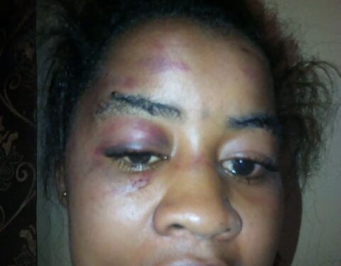 Aminatu Barrie Suffers Horrific Abuse; Police Didn’t Take Case Serious & Her Life Is In Danger